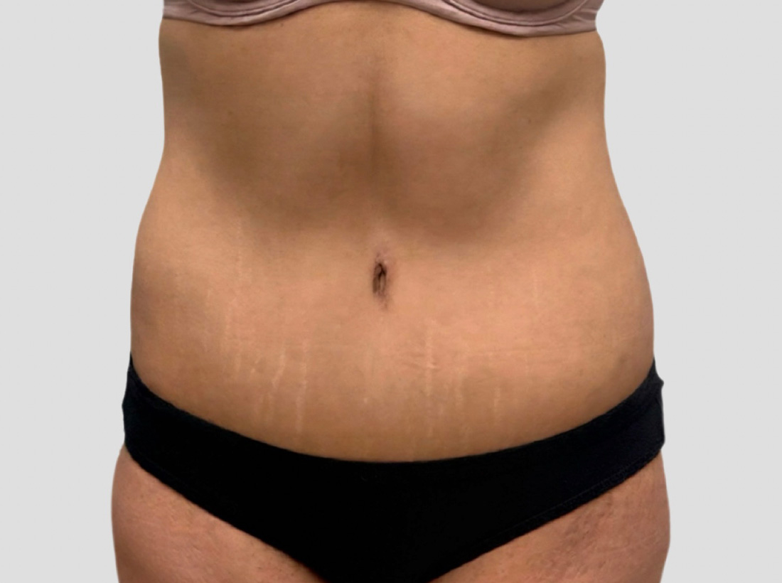 Liposuction Before and After 01