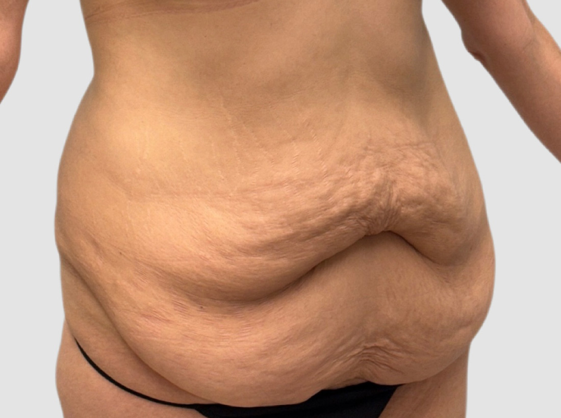 Liposuction Before and After 14