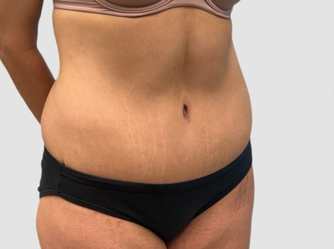 Liposuction Before and After 14