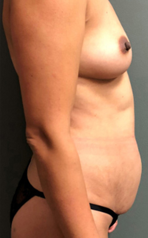 Mommy Makeover Before and After 06