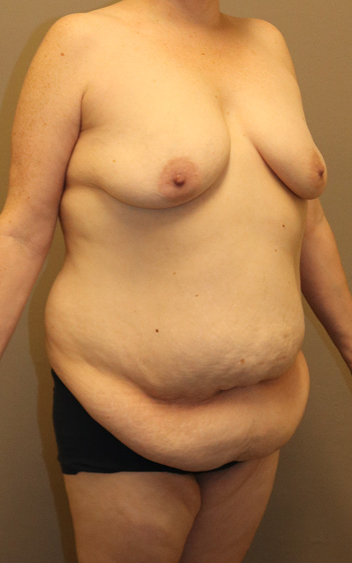 Mommy Makeover Before and After 12