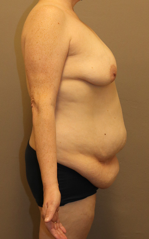 Mommy Makeover Before and After 12