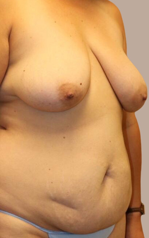 Mommy Makeover Before and After 13