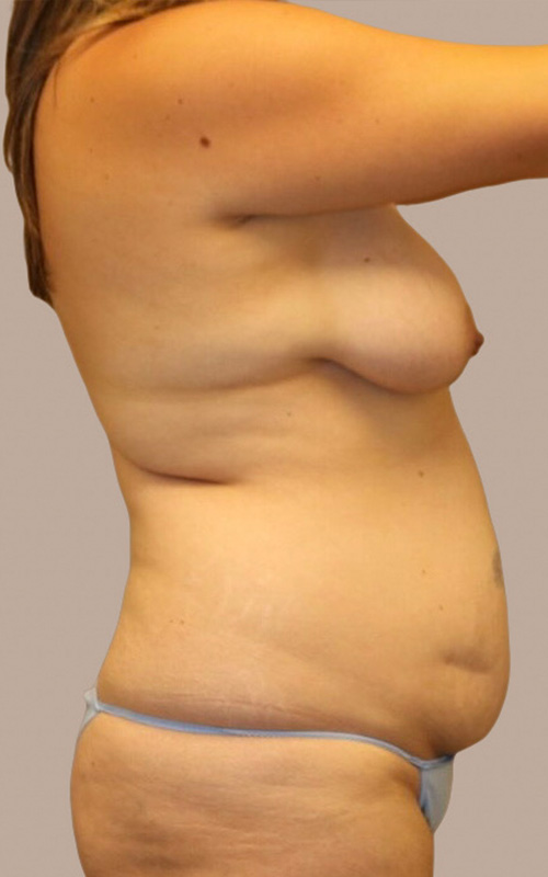 Mommy Makeover Before and After 13