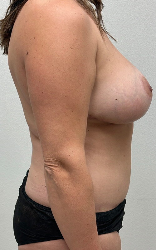 Mommy Makeover Before and After 13