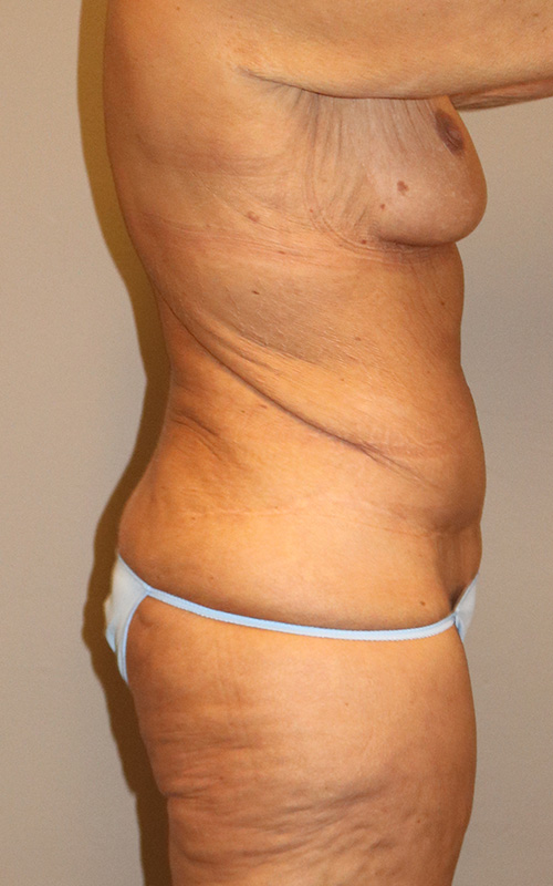 Mommy Makeover Before and After 14