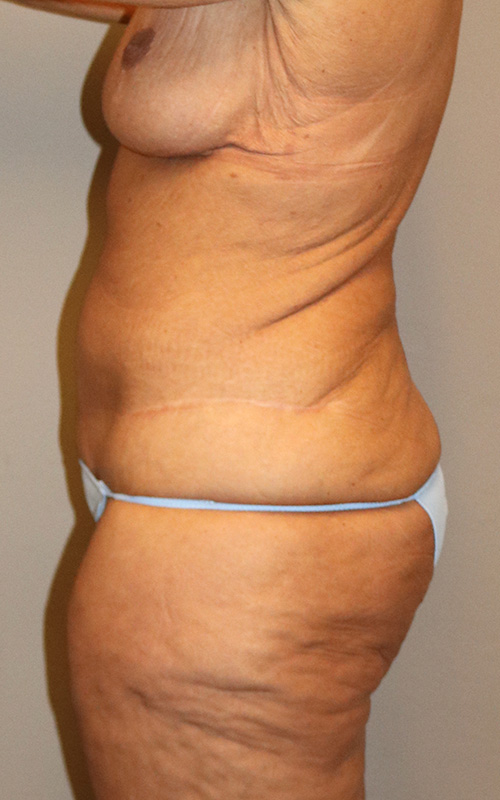 Mommy Makeover Before and After 14