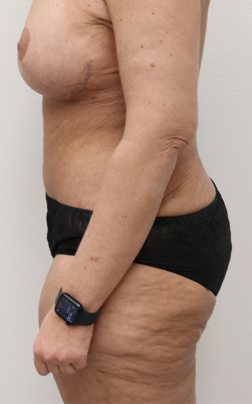 Mommy Makeover Before and After 14