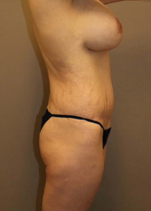 Mommy Makeover Before and After 15