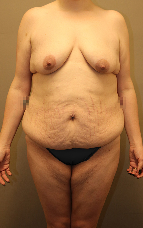 Mommy Makeover Before and After 16