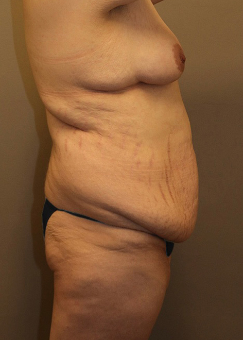 Mommy Makeover Before and After 16