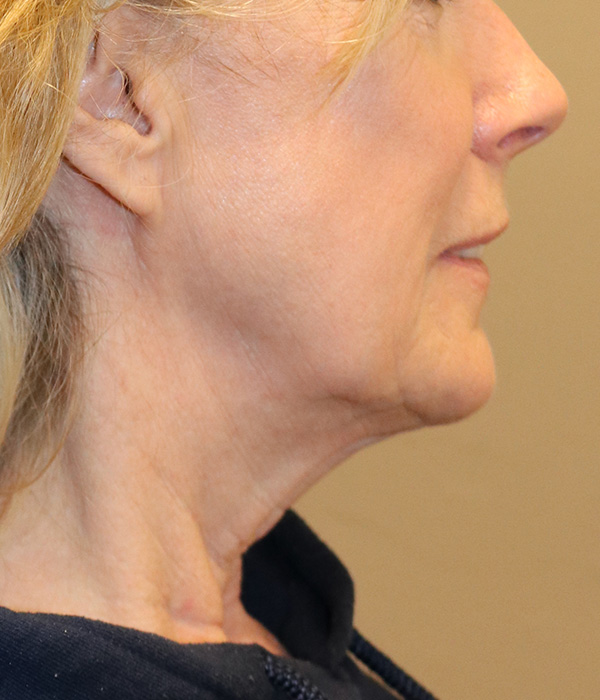 Neck Liposuction Before and After 01