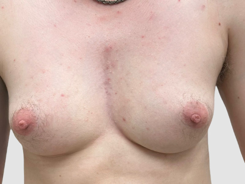 Transgender Ftm Top Surgery Before and After 02