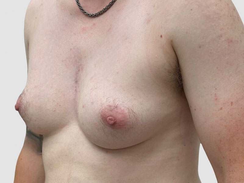 Transgender Ftm Top Surgery Before and After 02