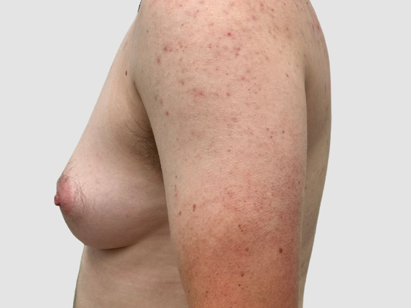 Transgender Ftm Top Surgery Before and After 02