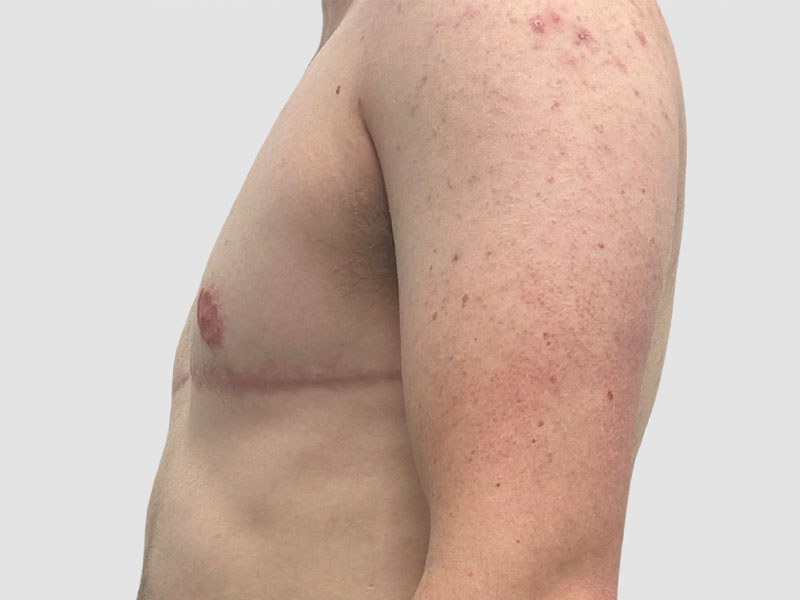 Transgender Ftm Top Surgery Before and After 02