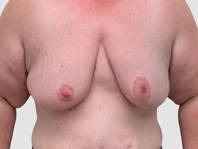 Transgender Ftm Top Surgery Before and After 06