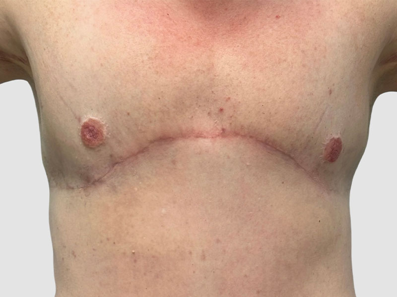 Transgender Ftm Top Surgery Before and After 01