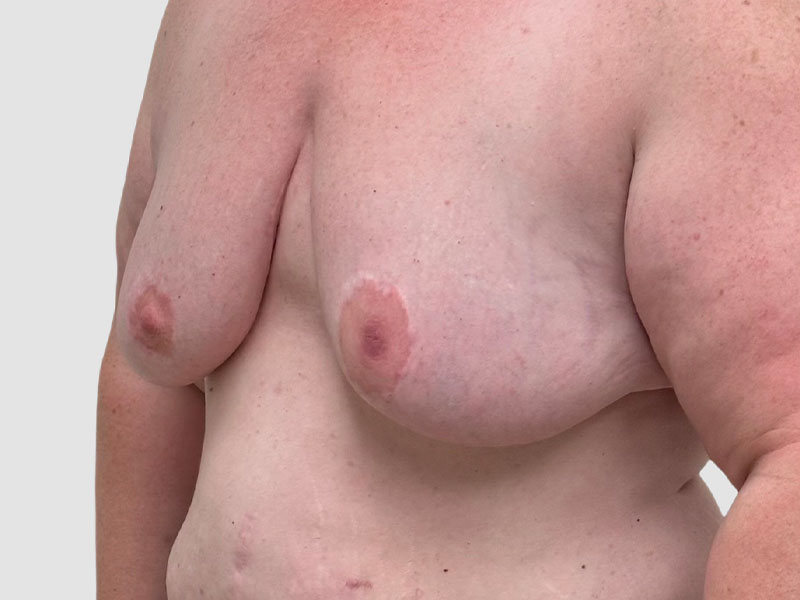 Transgender Ftm Top Surgery Before and After 06