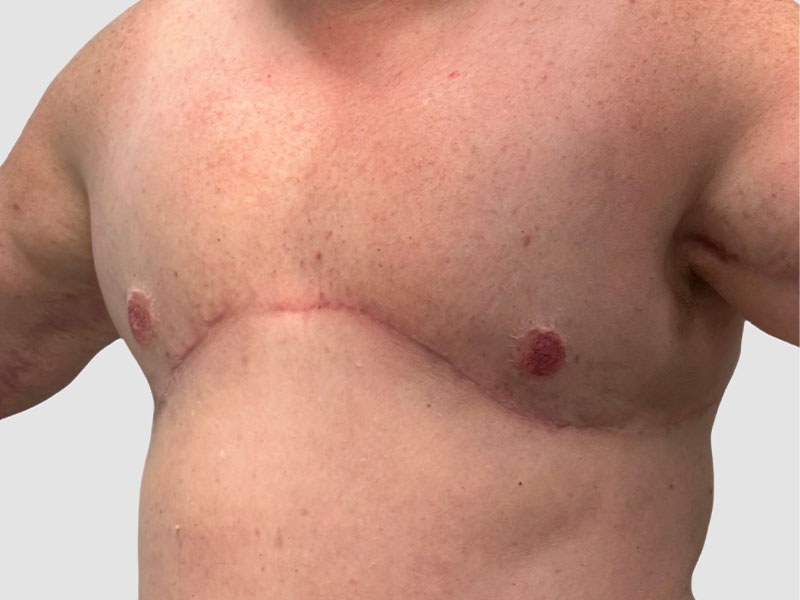 Transgender Ftm Top Surgery Before and After 06