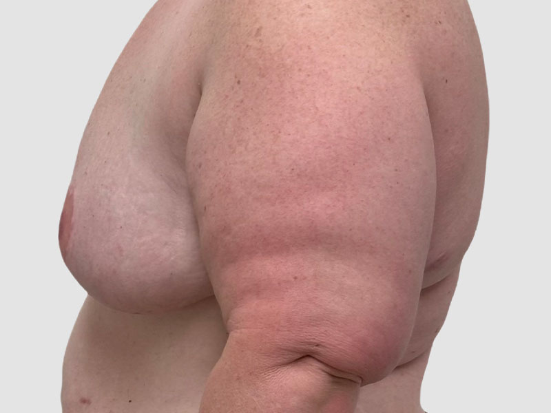 Transgender Ftm Top Surgery Before and After 06