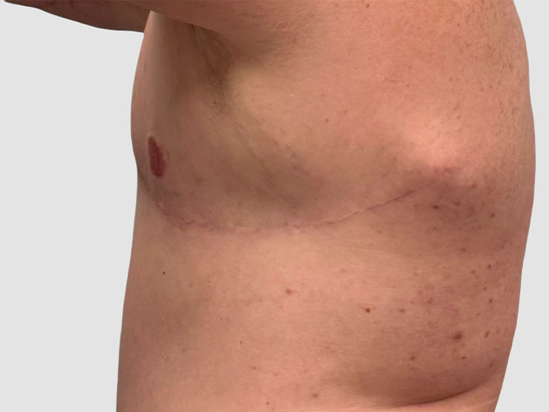 Transgender Ftm Top Surgery Before and After 06