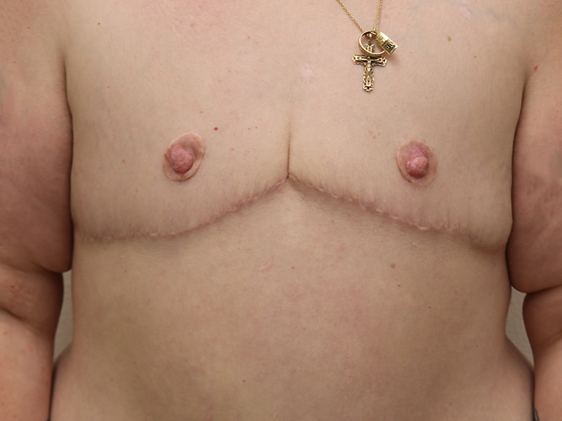 Transgender Ftm Top Surgery Before and After 01