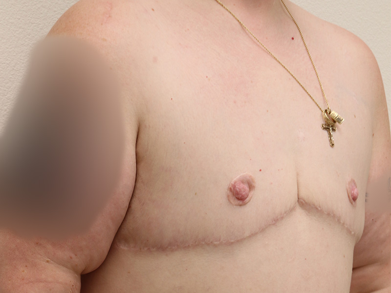 Transgender Ftm Top Surgery Before and After 07