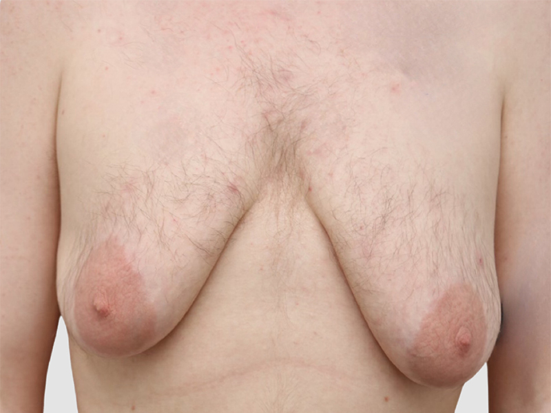 Transgender Ftm Top Surgery Before and After 08