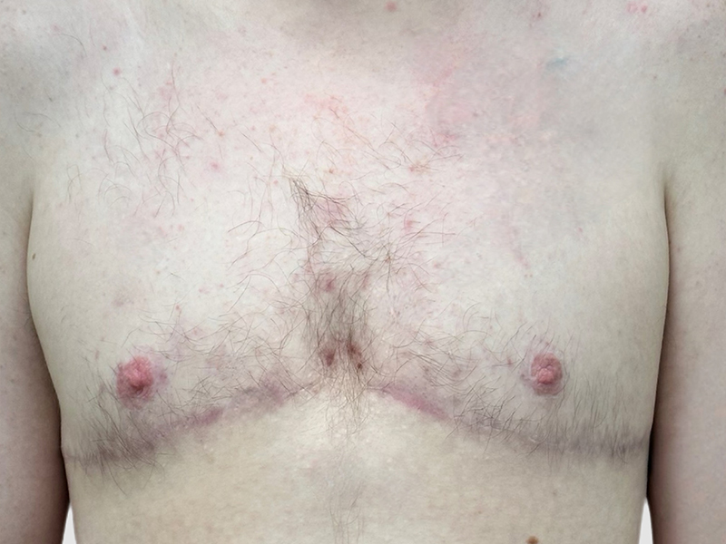 Transgender Ftm Top Surgery Before and After 01