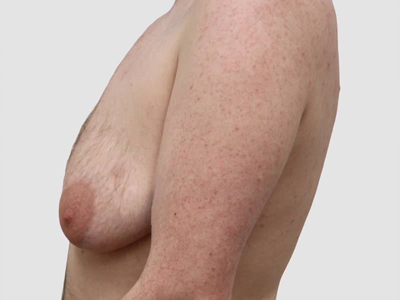 Transgender Ftm Top Surgery Before and After 08