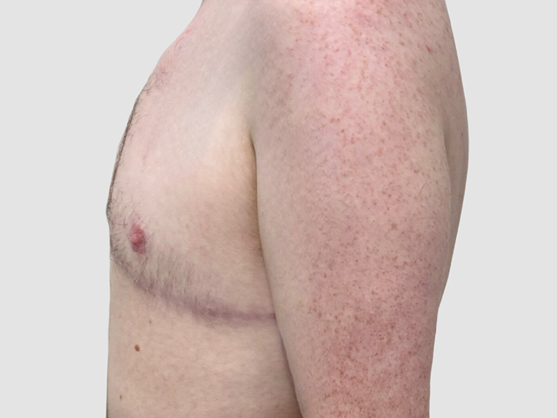 Transgender Ftm Top Surgery Before and After 08