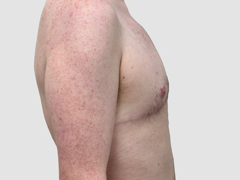 Transgender Ftm Top Surgery Before and After 08