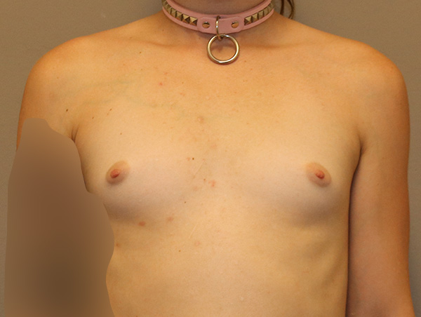 Transgender Mtf Breast Augmentation Before and After 01
