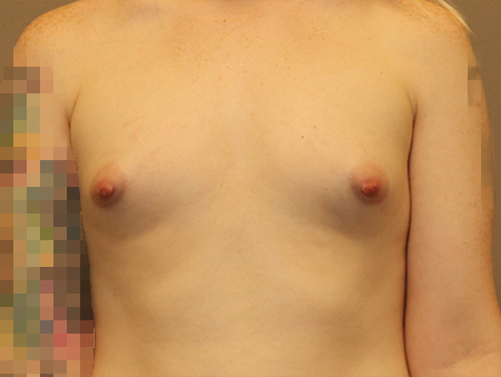 Transgender Mtf Breast Augmentation Before and After 02