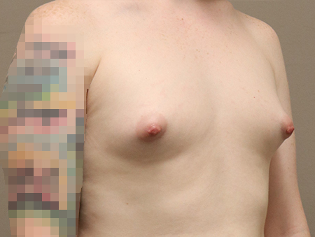 Transgender Mtf Breast Augmentation Before and After 02