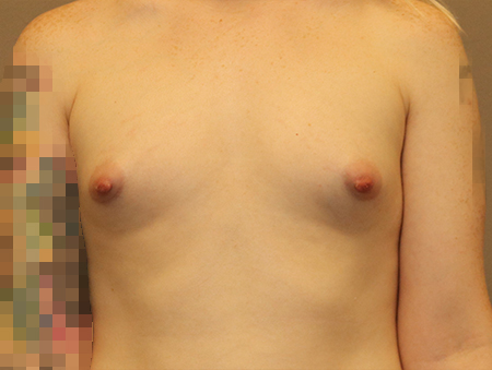 Transgender Mtf Breast Augmentation Before and After 03