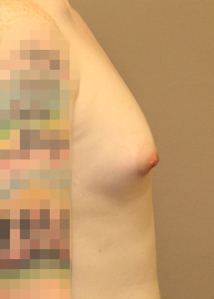 Transgender Mtf Breast Augmentation Before and After 03