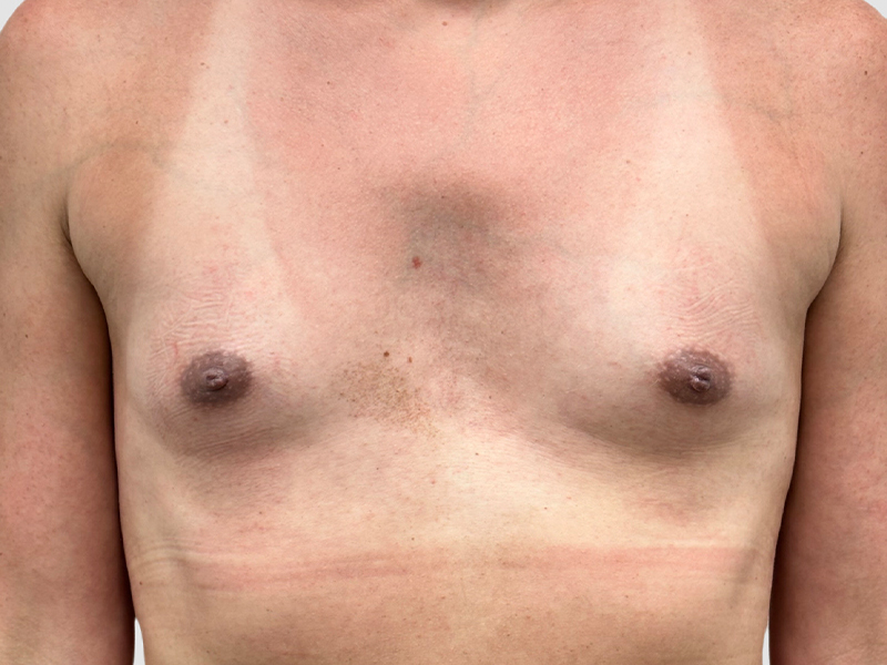 Transgender Mtf Breast Augmentation Before and After 04