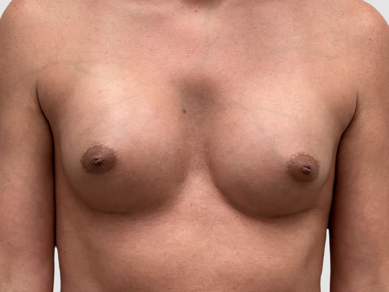 Transgender Mtf Breast Augmentation Before and After 03