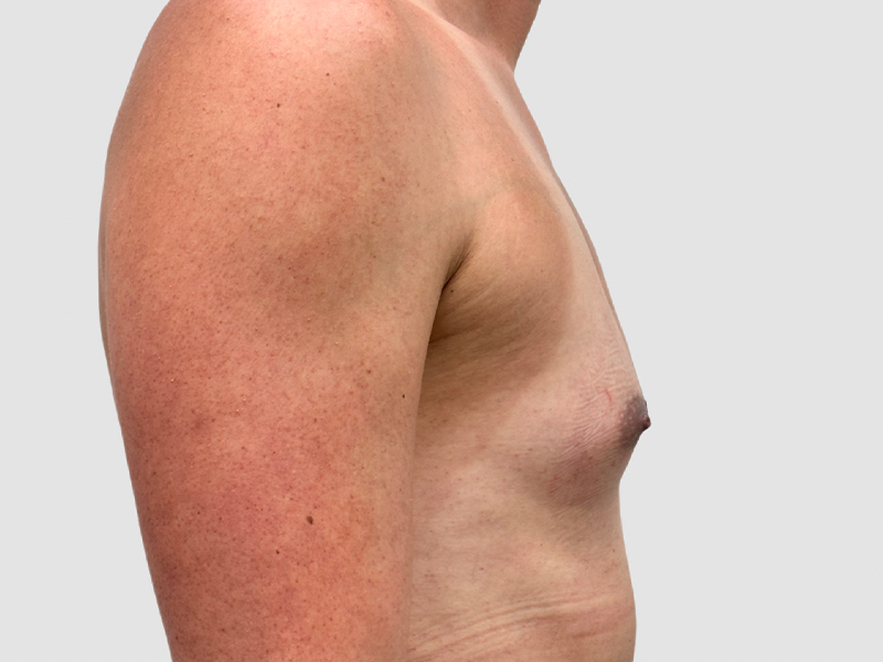 Transgender Mtf Breast Augmentation Before and After 04