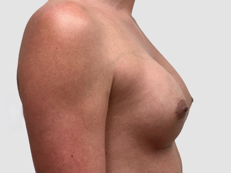 Transgender Mtf Breast Augmentation Before and After 04