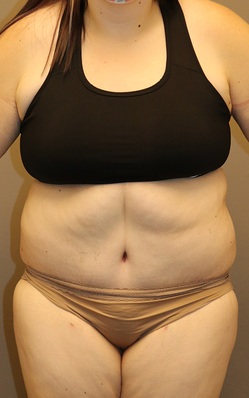 Tummy Tuck Before and After 03