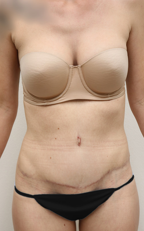 Tummy Tuck Before and After 17