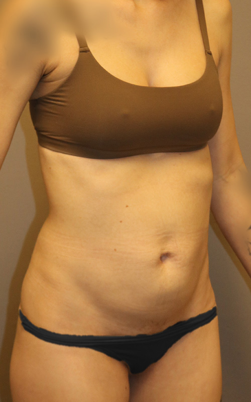 Tummy Tuck Before and After 07