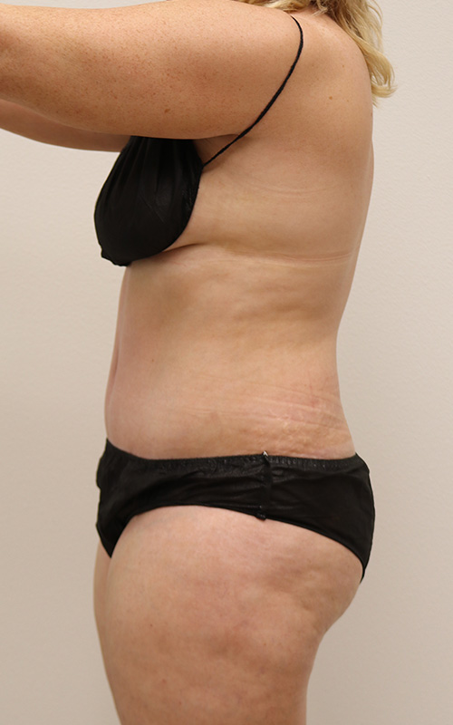 Tummy Tuck Before and After 14
