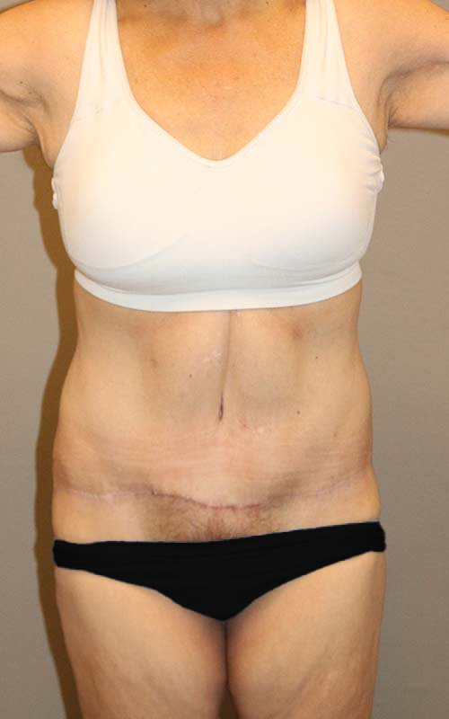 Tummy Tuck Before and After 12