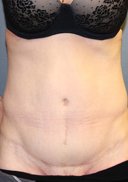 Tummy Tuck Before and After 10