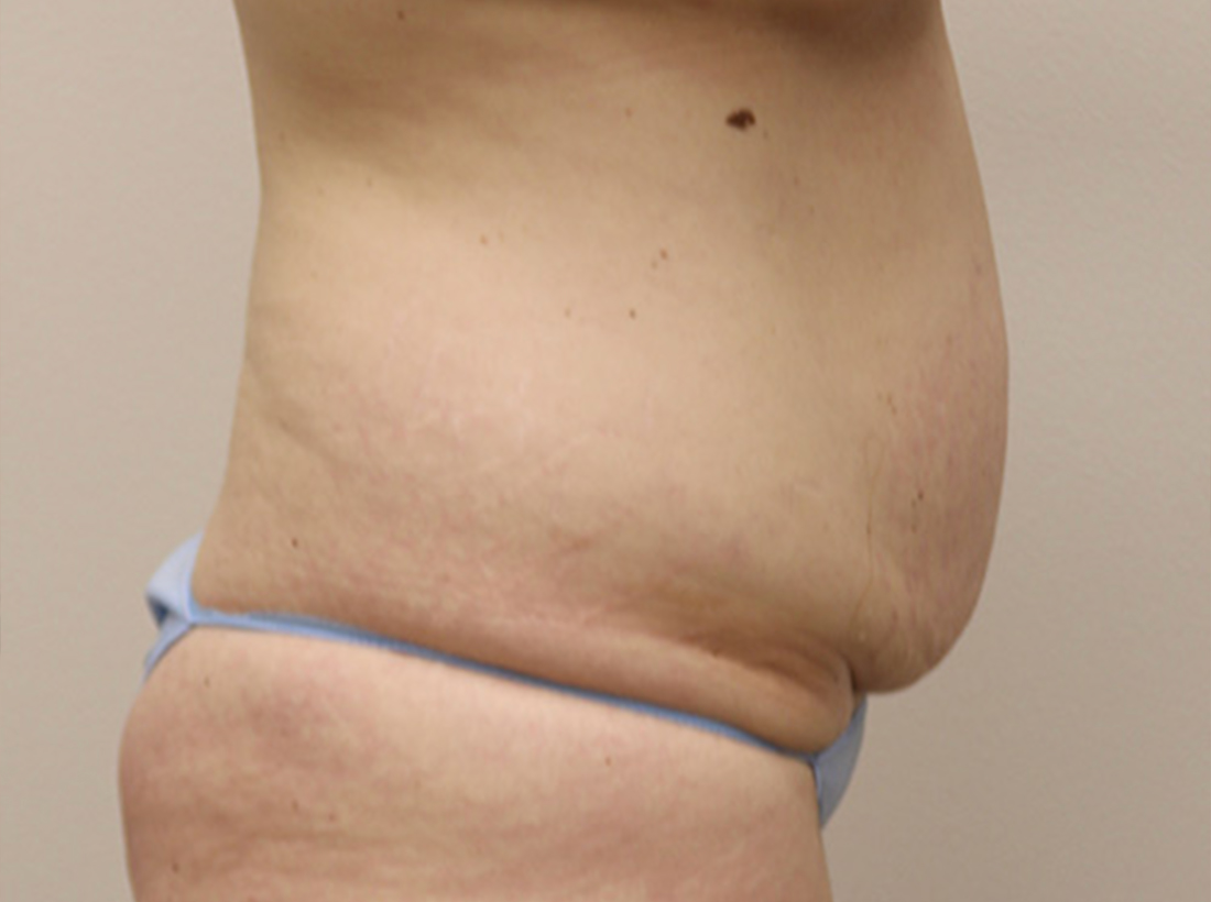 Tummy Tuck Before and After 24