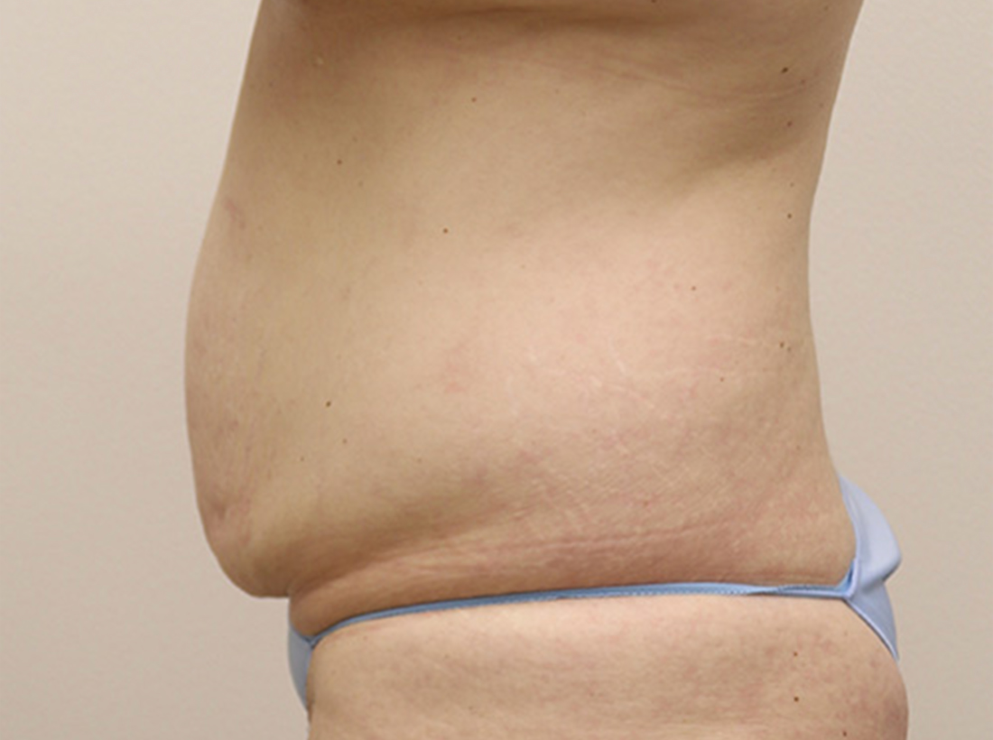 Tummy Tuck Before and After 24